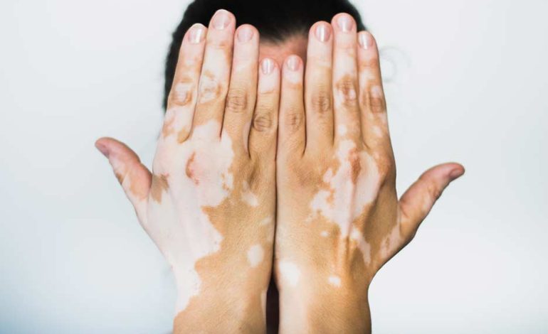 Día del Vitiligo Mundial: una fecha para hacer visible, comprender y seguir
– Primer plano