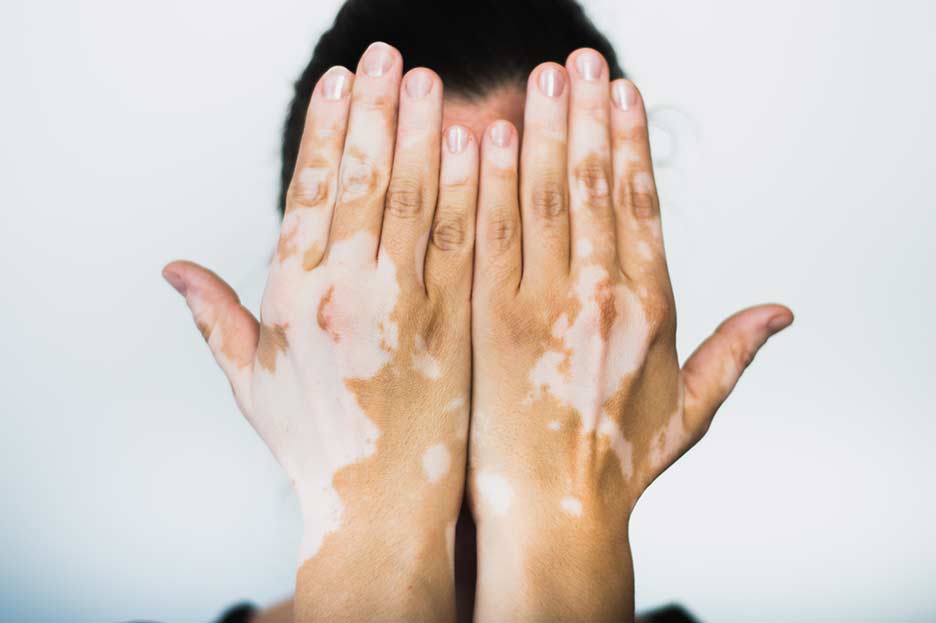 Día del Vitiligo Mundial: una fecha para hacer visible, comprender y seguir

 – Primer plano