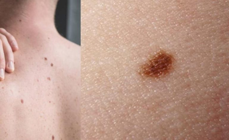 El día libre de verificar la luna está dirigido a prevenir el cáncer de piel
– Primer plano