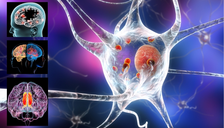 Nanoflores metálicas: el nuevo avance que promete tratar el Parkinson y el Alzheimer
 – Primer plano