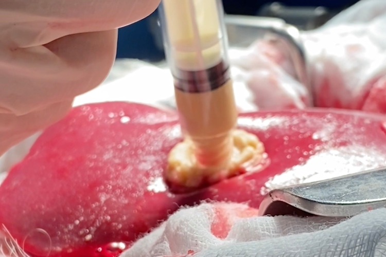 Adolescente crea gel de algas que detiene el sangrado

 – Primer plano