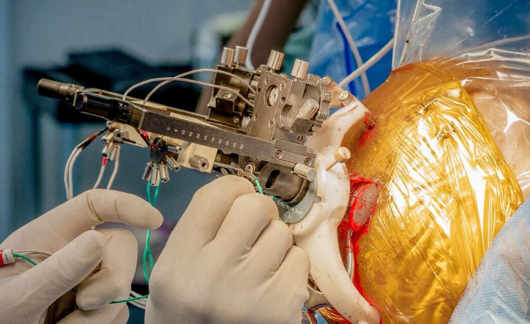 Innovador experimento médico en América Latina: implantación simultánea de chips en el cerebro para aliviar síntomas de la enfermedad de Parkinson

 – Primer plano