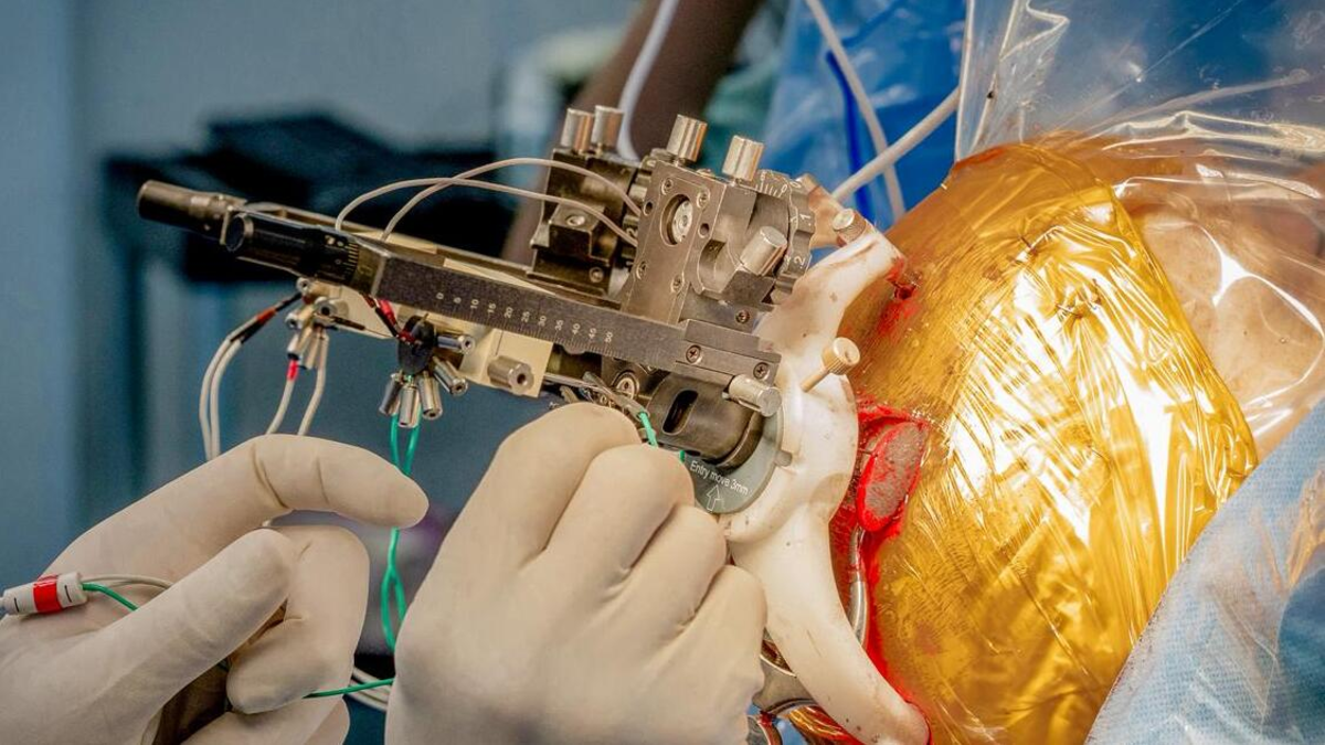 Innovador experimento médico en América Latina: implantación simultánea de chips en el cerebro para aliviar síntomas de la enfermedad de Parkinson

 – Primer plano