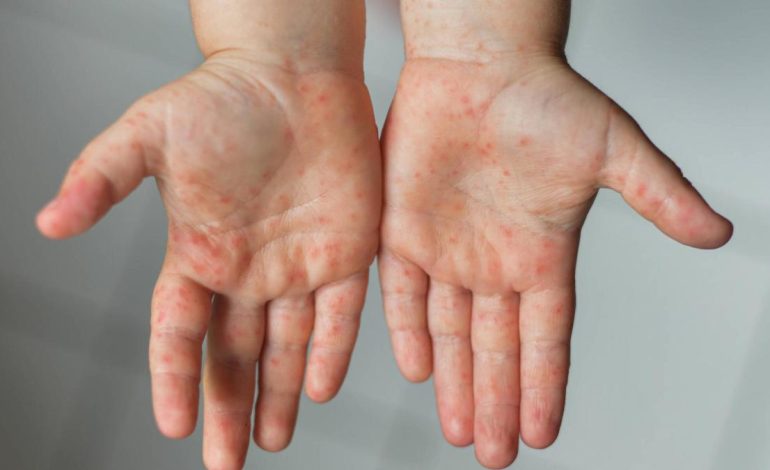 ¿En qué comuna se produjo la infección? autoridades dieron la alarma

 – Primer plano